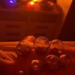 Ventosas de fuego sobre cliente en tratamiento postrado boca abajo en una camilla